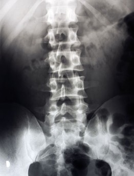 Lumbar Spine Fusion by OrangeCountySurgeons  